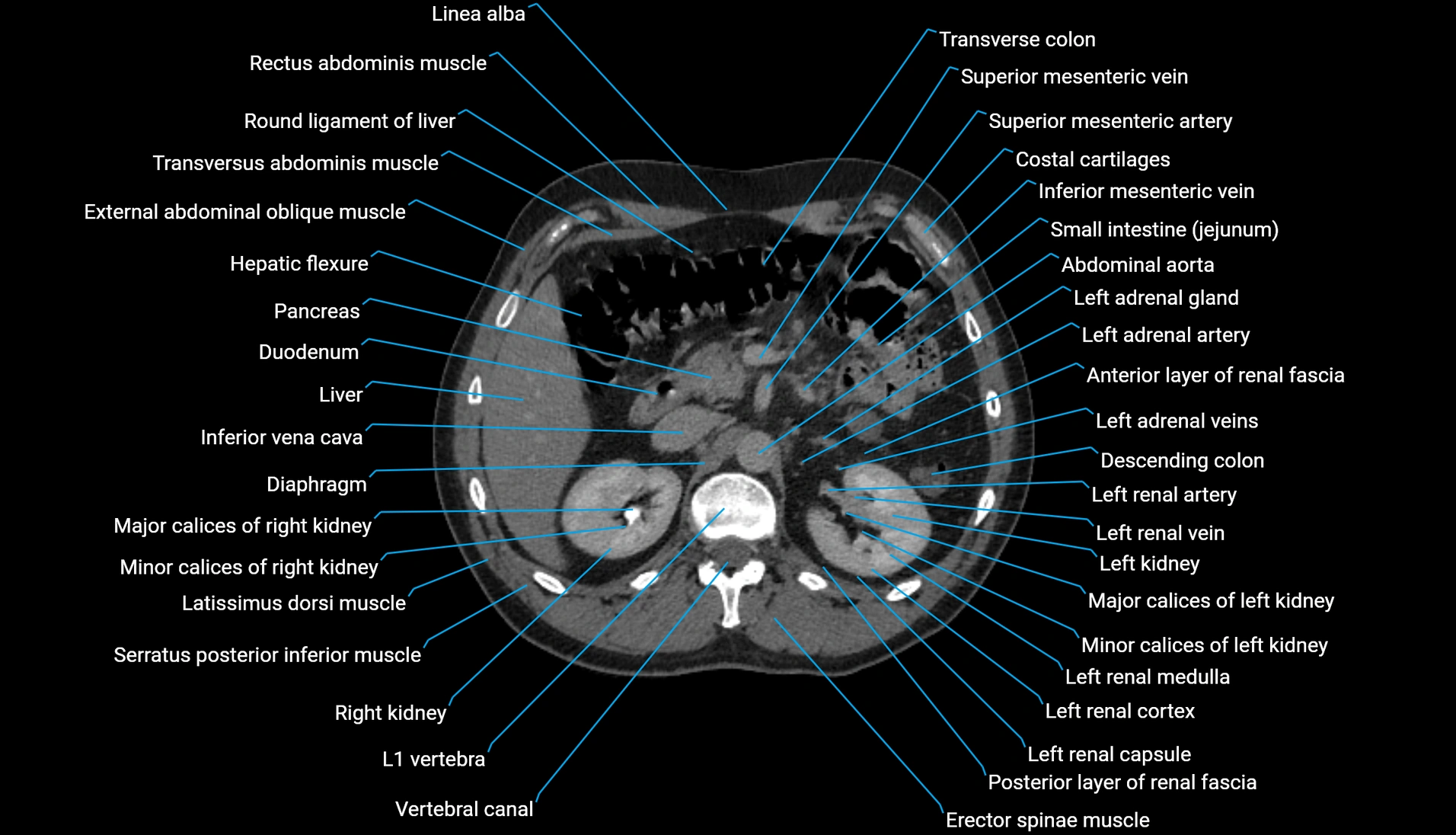 CT urogram axial cross sectional anatomy  labelled radiology image-00090.webp